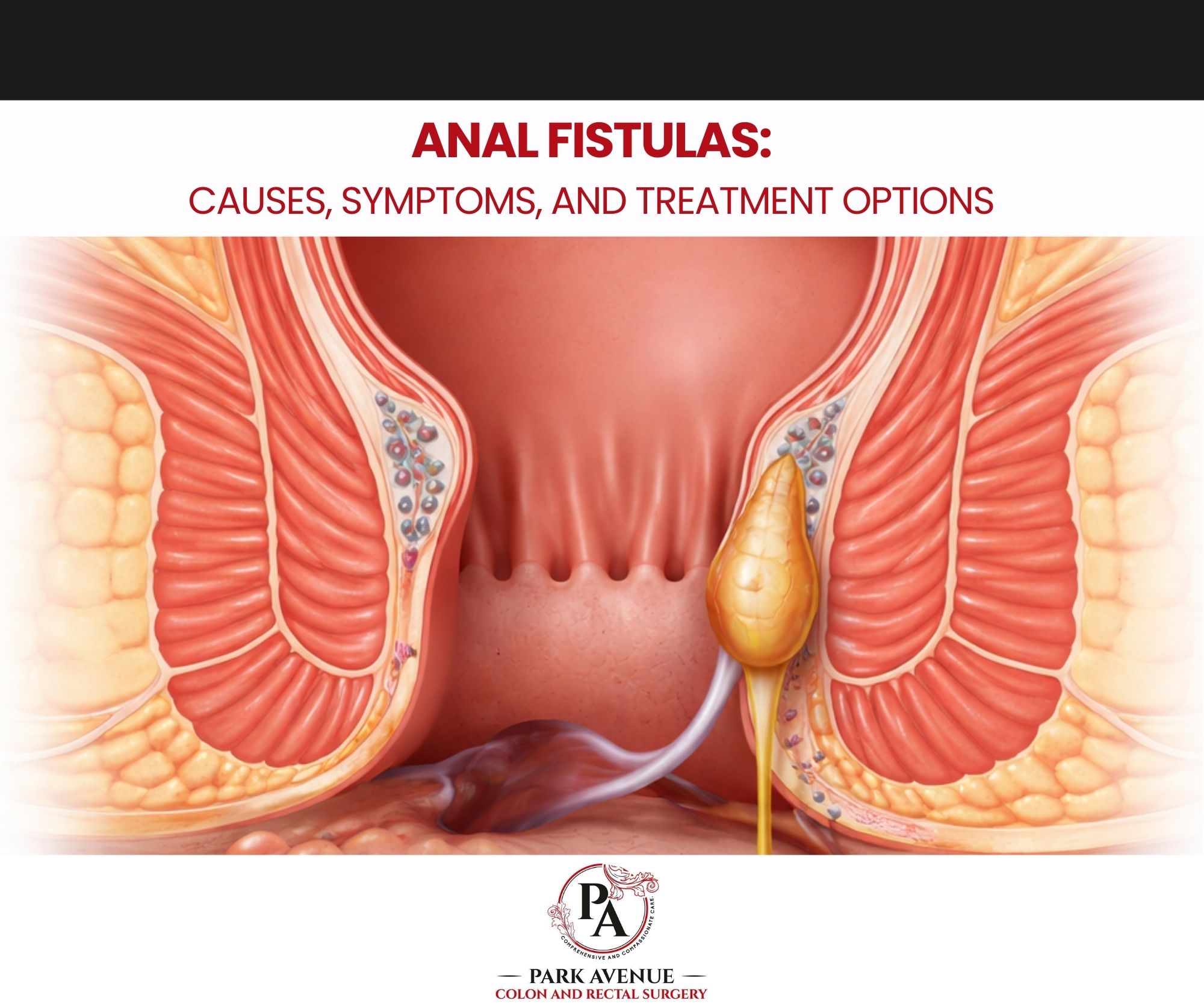 Anal Fistulas Causes, Symptoms, and Treatment Options