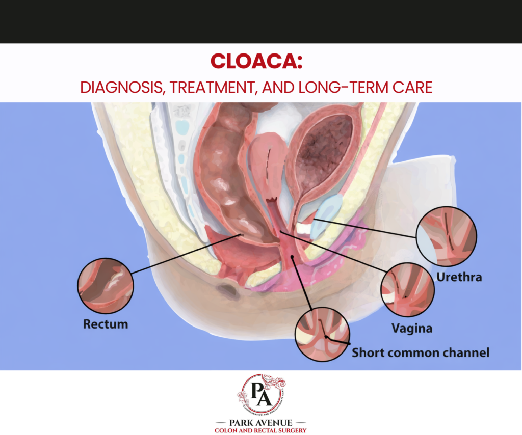 Cloaca Diagnosis, Treatment, and Long-Term Care