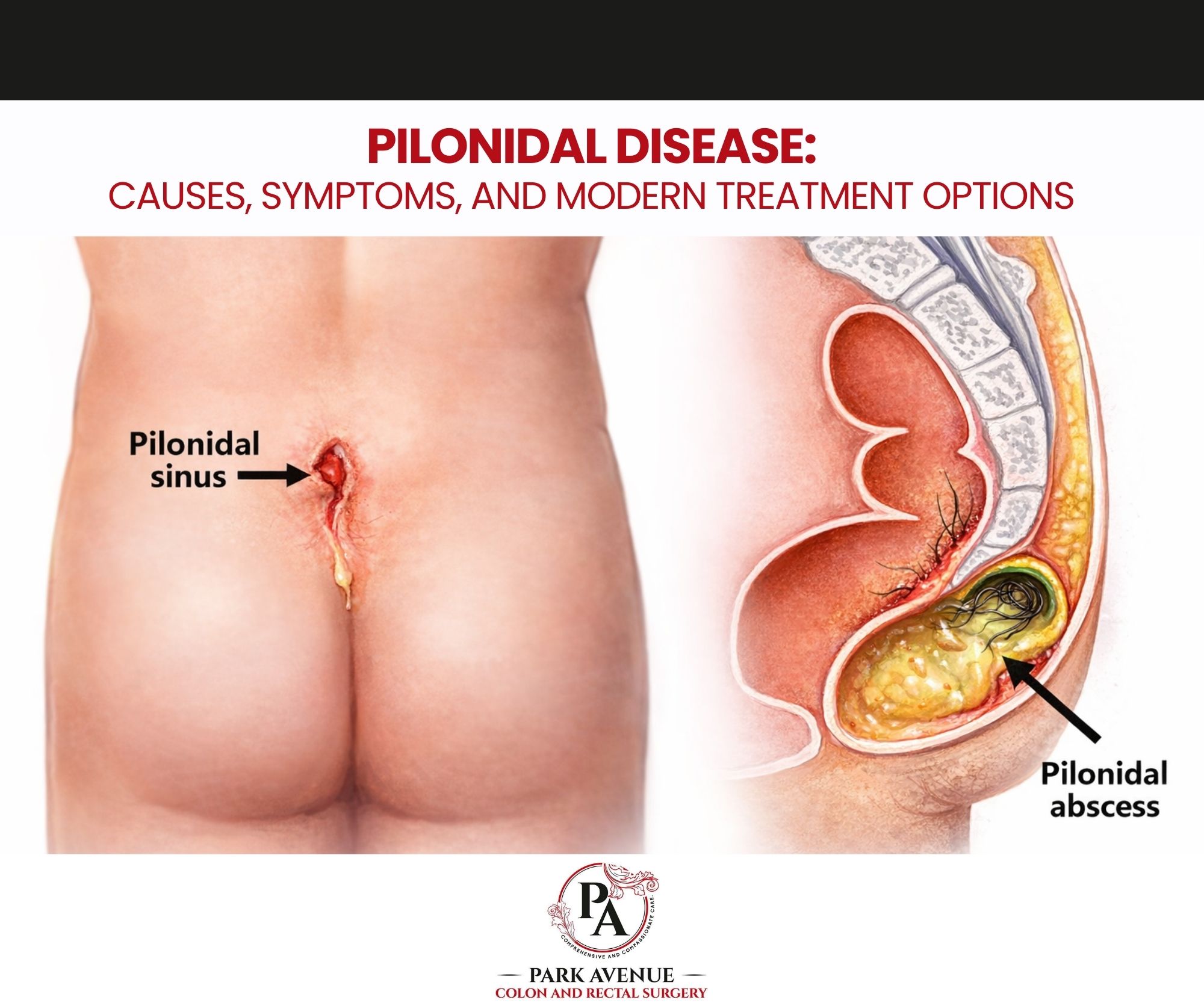 Pilonidal Disease: Causes, Symptoms, and Modern Treatment Options