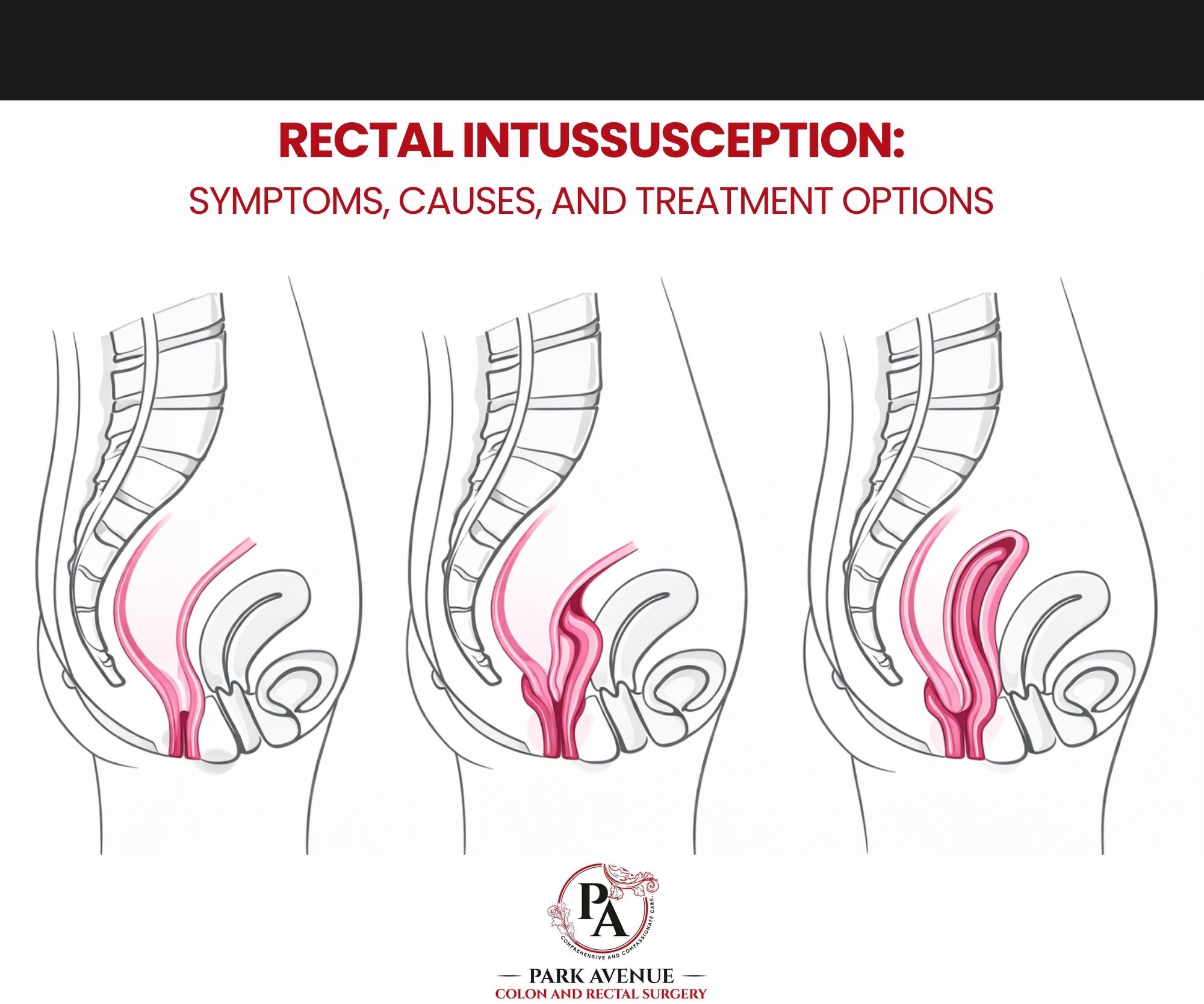 Rectal Intussusception: Symptoms, Causes, and Treatment Options