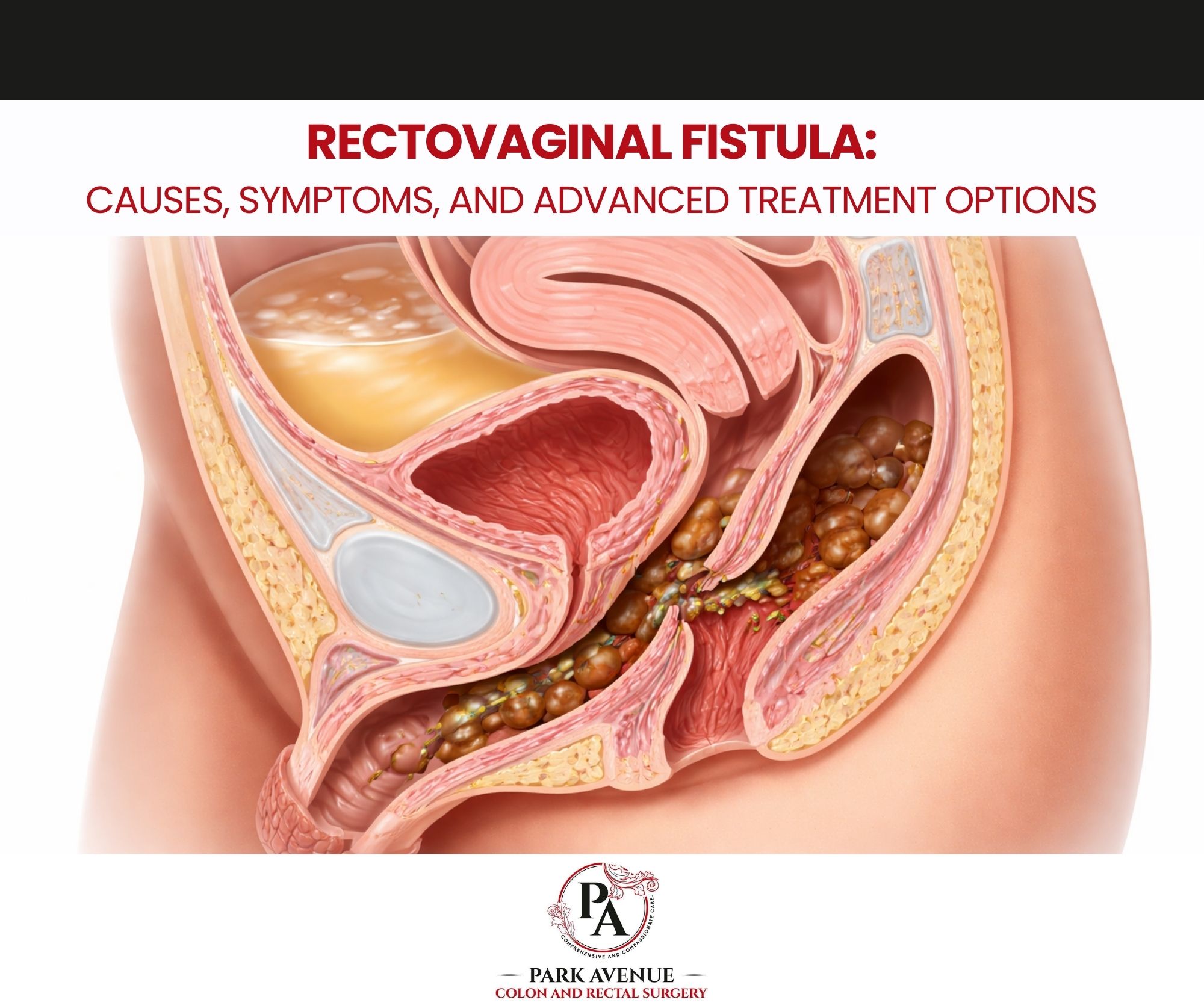 Rectovaginal Fistula: Causes, Symptoms, and Advanced Treatment Options